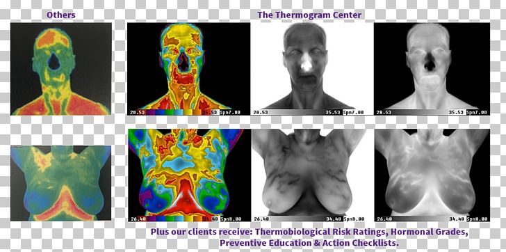 Thermography Medical Imaging Human Body Medicine PNG, Clipart, Breast, Breast Cancer, Cancer, Graphic Design, Head Free PNG Download