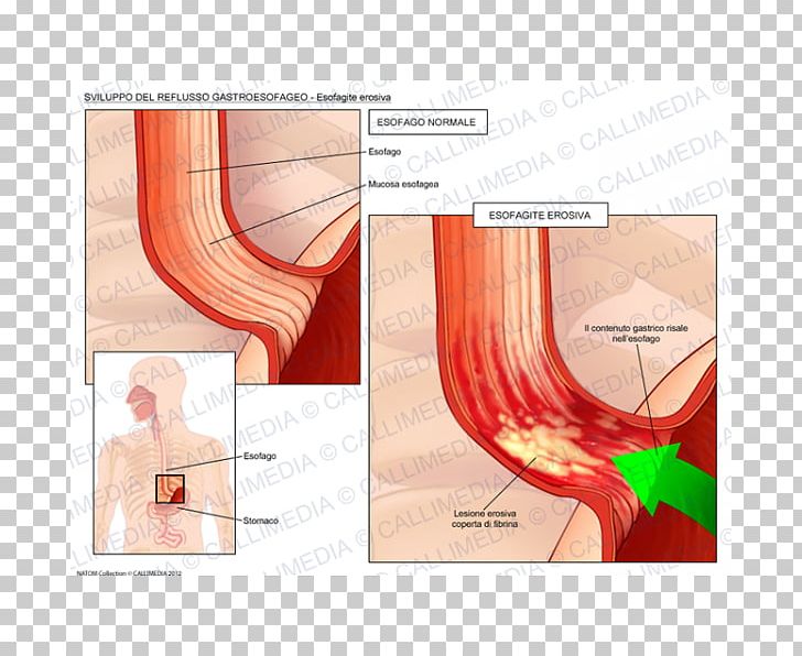 Gastroesophageal Reflux Disease Esophagus Esophagitis Cough PNG, Clipart,  Free PNG Download