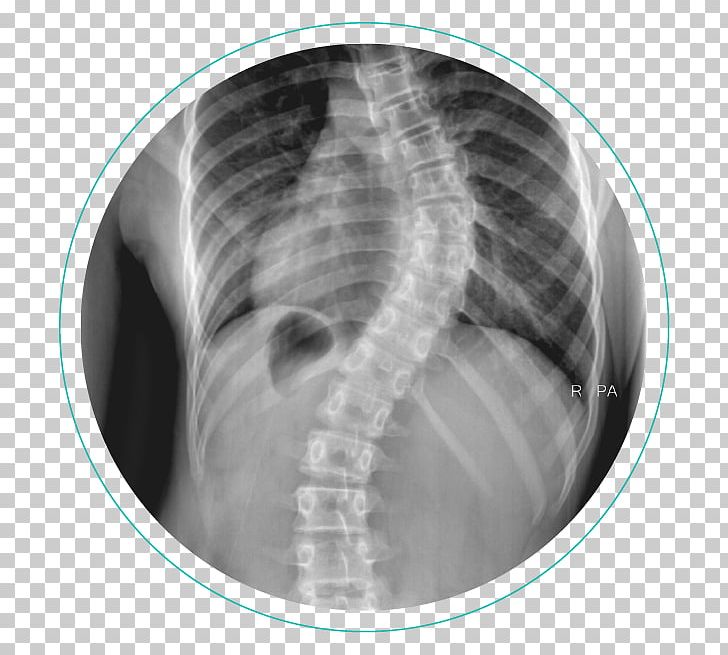 Scoliosis X-ray Vertebral Column Physical Therapy Cobb Angle PNG, Clipart, Back Pain, Black And White, Bone, Chest, Computed Tomography Free PNG Download