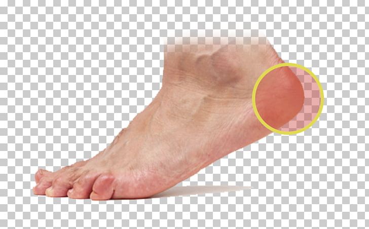 Foot Podiatry Skin Plantar Fasciitis Sole PNG, Clipart, Ankle, Athletes Foot, Callus, Clinic, Digit Free PNG Download