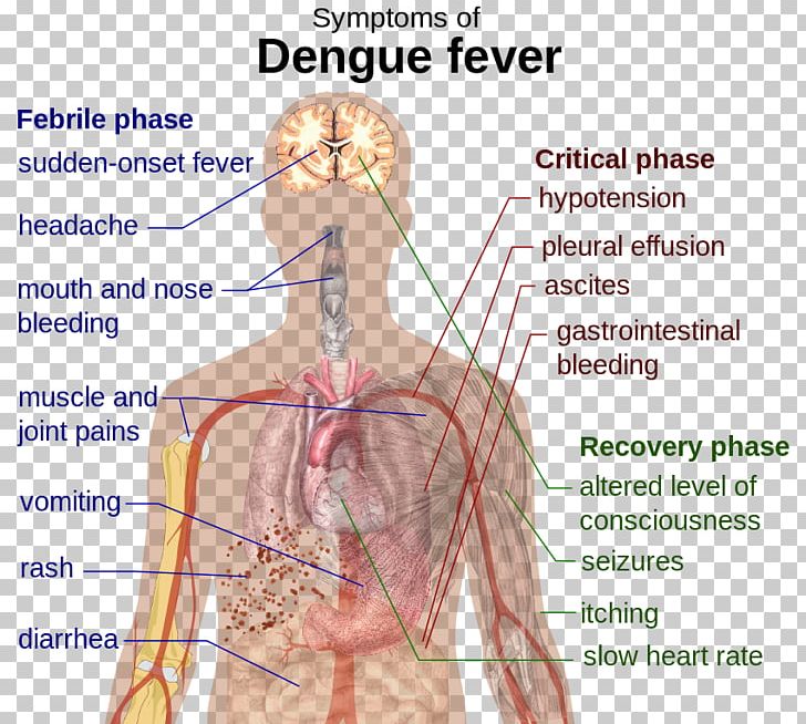 Mosquito Dengue Fever Scarlet Fever Disease Complication PNG, Clipart, Abdomen, Angle, Arm, Back, Blood Vessel Free PNG Download