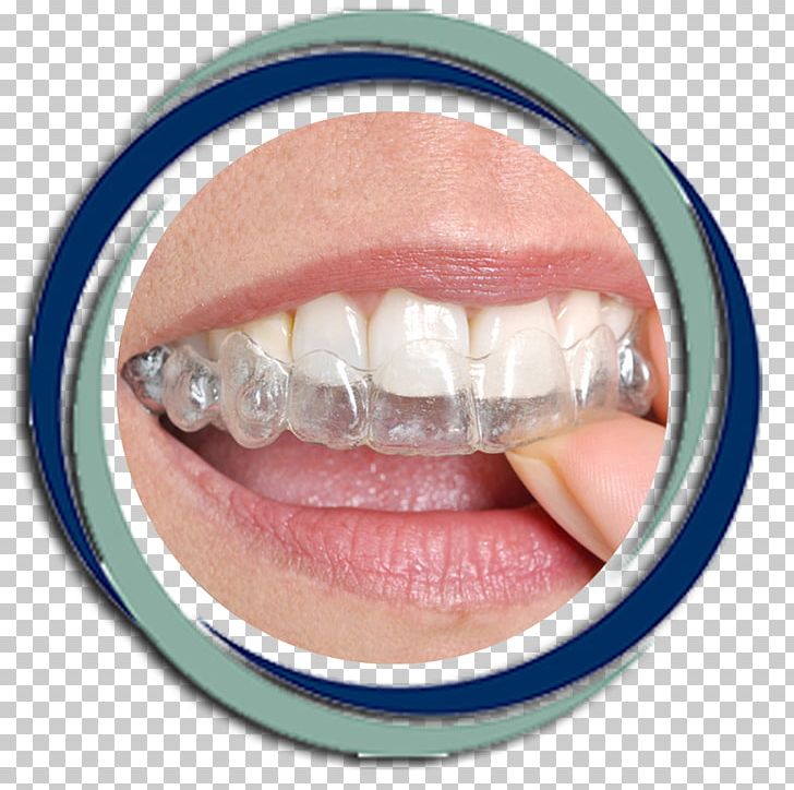 Clear Aligners Dental Braces Orthodontics Dentistry Tooth PNG, Clipart, Adolescence, Care, Clear Aligners, Cosmetic Dentistry, Dental Free PNG Download
