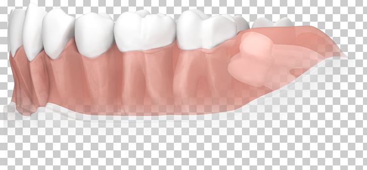 Tooth Apicoectomy Dental Surgery Dentistry PNG, Clipart, Aesthetics, Apicoectomy, Bonn, Dass, Dental Surgery Free PNG Download