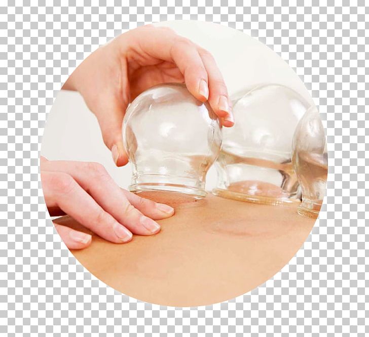 Cupping Therapy Bekam Medicine Massage PNG, Clipart, Acupuncture, Alternative Health Services, Blood, Chiropractic, Cupping Therapy Free PNG Download