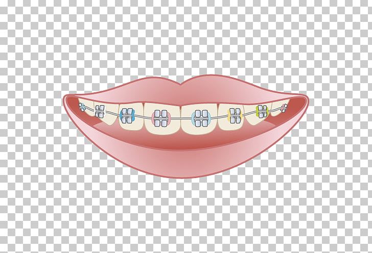 矯正歯科 Dentistry Dental Braces Mouthguard PNG, Clipart, Clinic, Damon System, Dental Braces, Dentist, Dentistry Free PNG Download