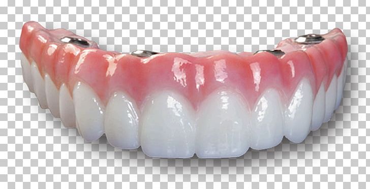 Dental Implant Bridge Dentures Dentistry All-on-4 PNG, Clipart, Abutment, Allon4, Arch, Bridge, Cadcam Dentistry Free PNG Download
