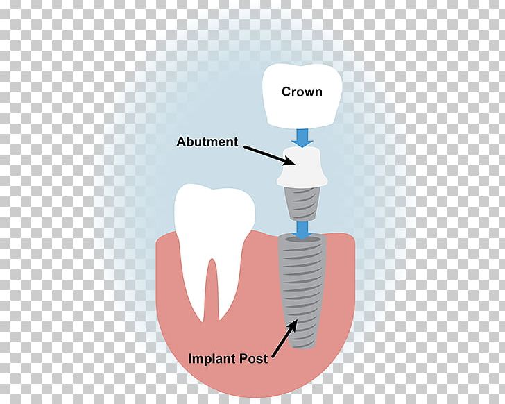 Dental Implant Dentistry Surgery PNG, Clipart, Bone Grafting, Brand, Communication, Crown, Dental Assistant Free PNG Download