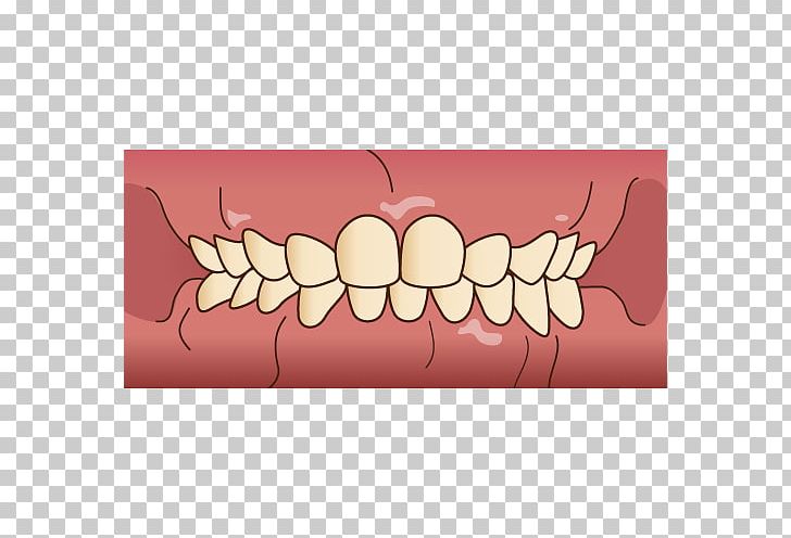 Tooth Dentist 歯科 Prognathism Dental Hygienist PNG, Clipart, Bruxism, Dental Hygienist, Dental Surgery, Dentist, Dentistry Free PNG Download