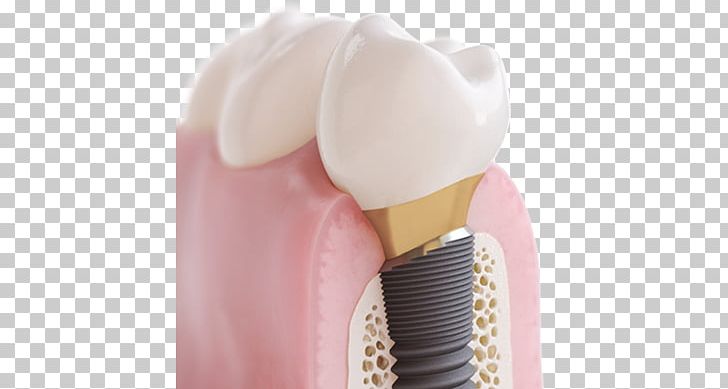 Dental Implant Cosmetic Dentistry Tooth PNG, Clipart, Bridge, Brush, Cosmetic Dentistry, Crown, Dental Implant Free PNG Download