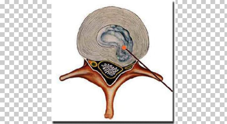 Spinal Disc Herniation Therapy Spinal Cord Intervertebral Disc 急性腰痛症 PNG, Clipart, Ache, Acupuncture, Beak, Disease, Health Care Free PNG Download