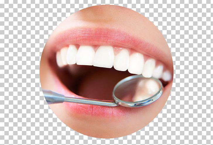 Dentistry Scaling And Root Planing Dental Implant Teeth Cleaning PNG, Clipart, Dental Implant, Dental Public Health, Dentist, Dentistry, Gums Free PNG Download