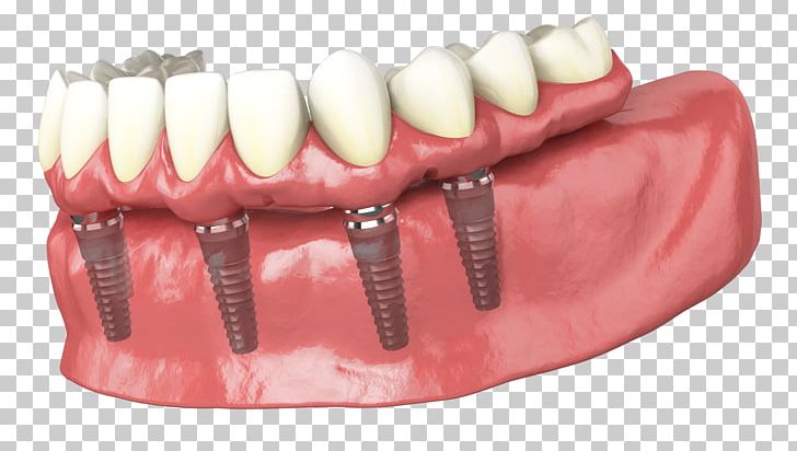 Tooth Dental Implant Dentures Dentistry PNG, Clipart, Bridge, Dental Implant, Dentist, Dentistry, Dentures Free PNG Download