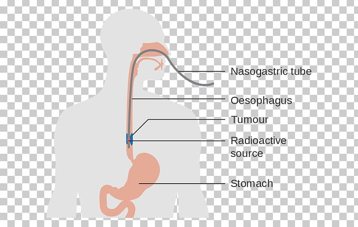 Esophagus Esophageal Cancer Esophageal Dysphagia Esophagectomy PNG, Clipart, Abdomen, Angle, Arm, Cancer Staging, Carcinoma Free PNG Download