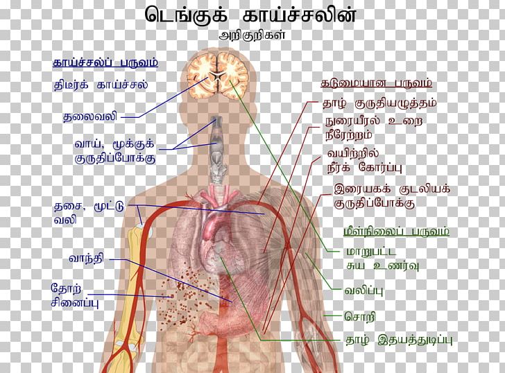 Dengue Virus Fever Symptom Infection PNG, Clipart, Abdomen, Angle, Arm, Dengue Fever, Disease Free PNG Download