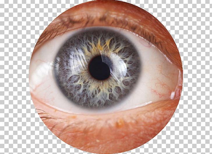 Glaucoma Eye Iridology Health Therapy PNG, Clipart,  Free PNG Download