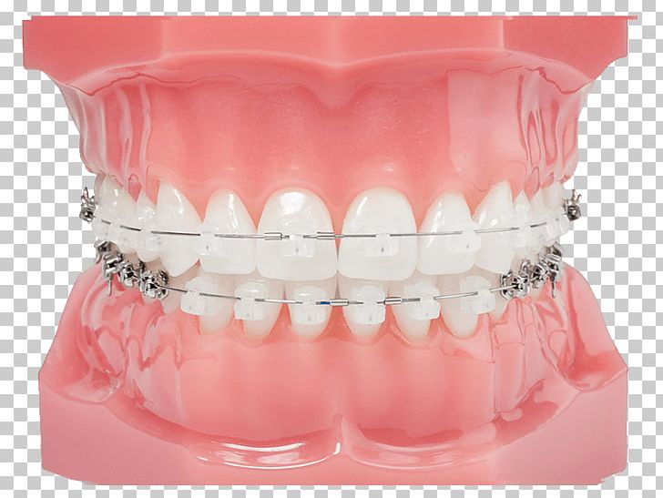 Damon System Clear Aligners Dental Braces Orthodontics Dentistry PNG, Clipart, Aparat, Clear Aligners, Cosmetic Dentistry, Crossbite, Damon System Free PNG Download
