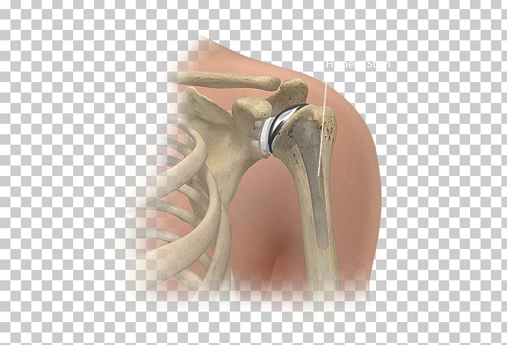 Shoulder Replacement Joint Replacement Surgery Knee Replacement PNG, Clipart, Ankle, Arthrodesis, Dalton, Finger, Hand Free PNG Download