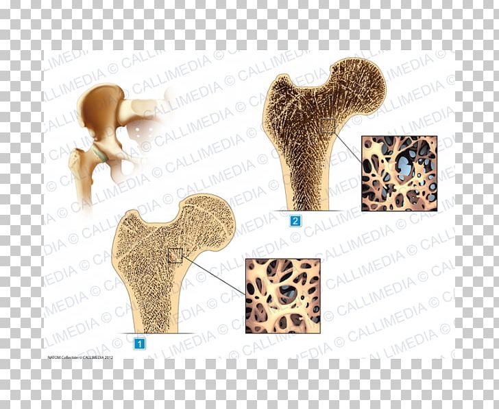 Hip Osteoporosis Rheumatology Illustration Anatomique Osteoarthritis PNG, Clipart, Acetabulum, Anatomy, Banco De Imagens, Bone Fracture, Ear Free PNG Download