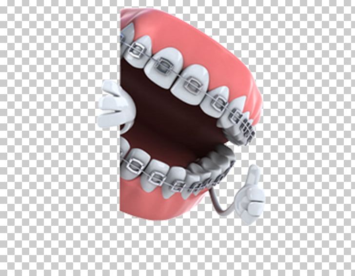 Dentistry Orthodontics Dental Braces Tooth Medicine PNG, Clipart, Blanco, Clinic, Cosmetic Dentistry, Dental, Dental Braces Free PNG Download