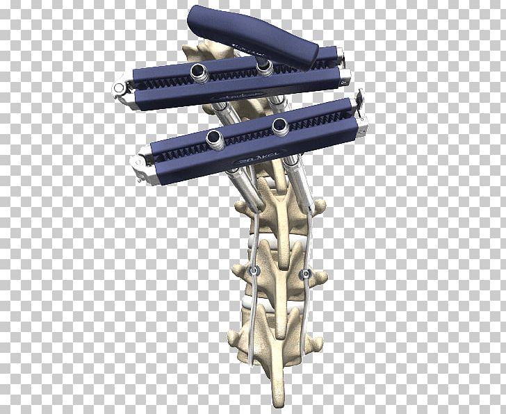 Vertebral Column Surgery Spinal Fusion Stryker Corporation PNG, Clipart, Angle, Finance, Hardware, Health, Machine Free PNG Download