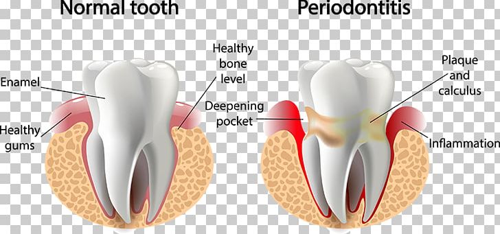 Periodontal Disease Gums Periodontology Dentistry PNG, Clipart, Dental Plaque, Dentist, Disease, Ear, Gingivitis Free PNG Download