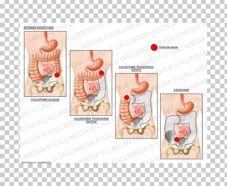 Stoma Ileostomy Ostomía Digestion Colostomy PNG, Clipart, Abdomen, Anatomy, Coloplast, Colostomy, Degree Free PNG Download