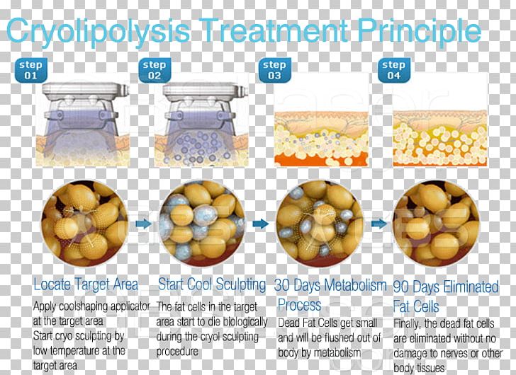 Cryolipolysis Adipose Tissue Adipocyte Fat Apoptosis PNG, Clipart, Adipocyte, Adipose Tissue, Apoptosis, Body Contouring, Cell Free PNG Download
