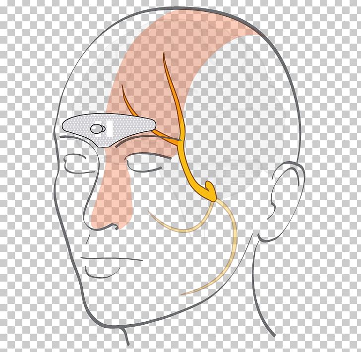 Ear Forehead Cefaly Electrode Migraine PNG, Clipart, Electrode, Eye, Face, Fictional Character, Glasses Free PNG Download