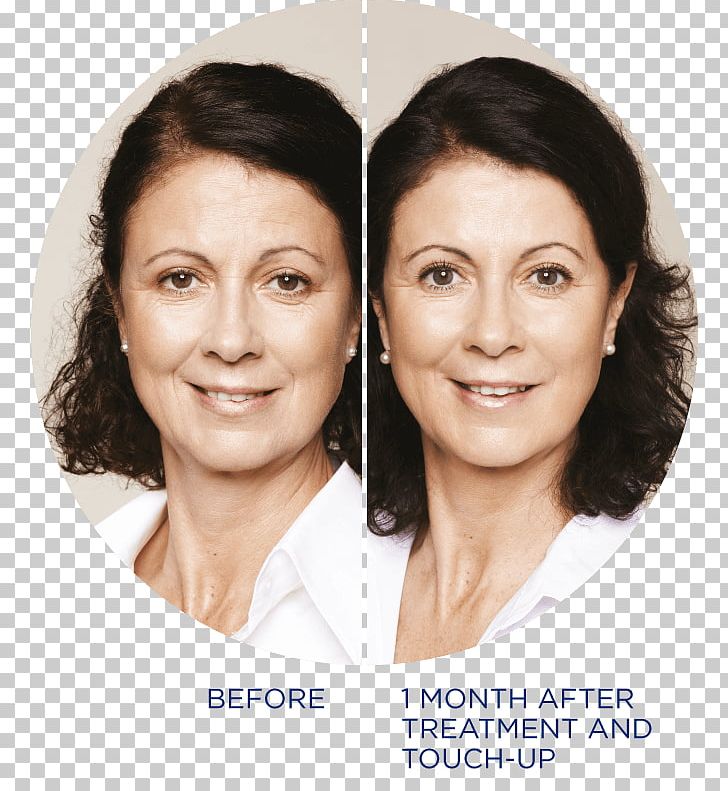 Restylane Injectable Filler Nasolabial Fold Botulinum Toxin PNG, Clipart, Beauty, Before After, Botulinum Toxin, Cheek, Chin Free PNG Download