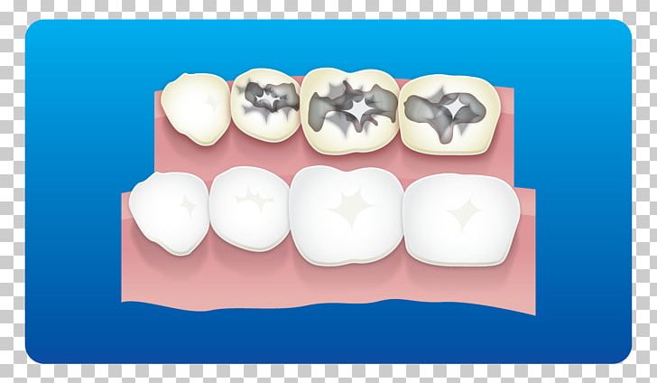 Tooth PNG, Clipart, Brackets, Care, Cosmetic Dentistry, Dental, Dental Care Free PNG Download