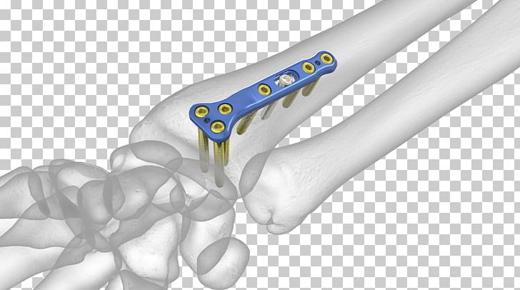 Lunate Bone Distal Radius Fracture Radial Styloid Process PNG, Clipart, Acu, Bone, Bone Fracture, Bone Grafting, Distal Free PNG Download