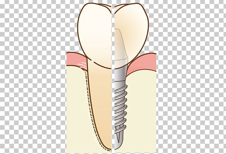 Dentist 歯科 Dental Implant Therapy Dentures PNG, Clipart, Bridge, Dental Implant, Dental Surgery, Dentist, Dentures Free PNG Download