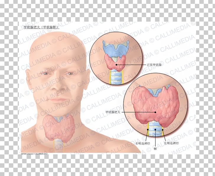 Nodule Goitre Graves' Disease Hyperthyroidism PNG, Clipart, Chin, Disease, Ear, Face, Finger Free PNG Download