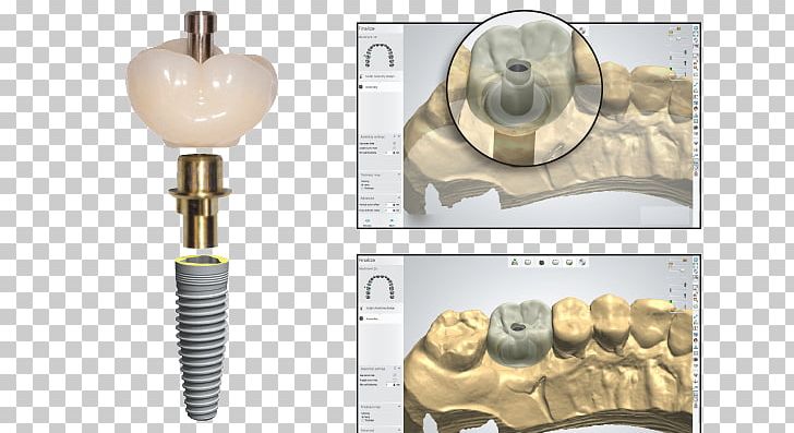 Dental Implant Temporary Crown Screw PNG, Clipart, Bone, Brass, Cadcam Dentistry, Cement, Crown Free PNG Download