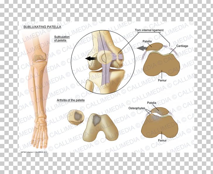 Patella Subluxation Bone Shoulder Pulled Elbow PNG, Clipart, Anatomy, Animal, Arm, Bone, Dimension Free PNG Download