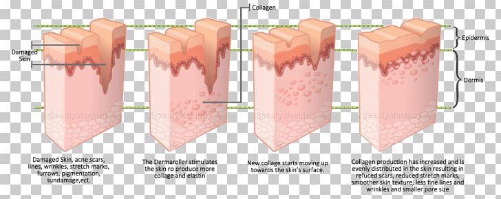 Collagen Induction Therapy Dermis Skin Care PNG, Clipart, Acne, Angle, Collagen, Collagen Induction Therapy, Cosmetics Free PNG Download