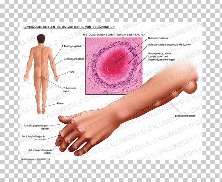 Rheumatoid Nodule Rheumatoid Arthritis Rheumatism Disease PNG, Clipart,  Free PNG Download