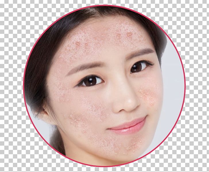 Mụn Eyebrow Acne Forehead Skin Care PNG, Clipart, Acne, Cheek, Chin, Closeup, Ear Free PNG Download