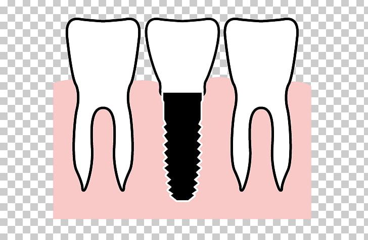 Tooth Gums Therapy Health Dental Implant PNG, Clipart, Dental Implant, Finger, Gums, Hand, Health Free PNG Download