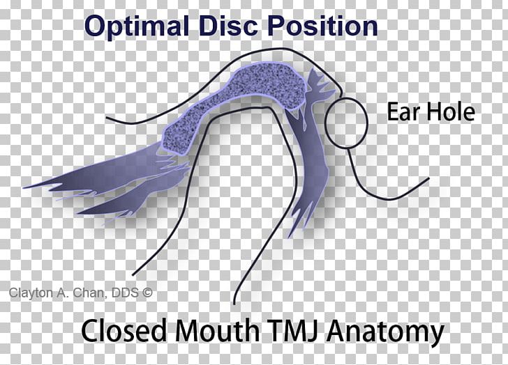 Temporomandibular Joint Dysfunction Syndrome Occlusion Disease PNG, Clipart, Anatomy, Arthroscopy, Articular Disk, Chewing, Computed Tomography Free PNG Download