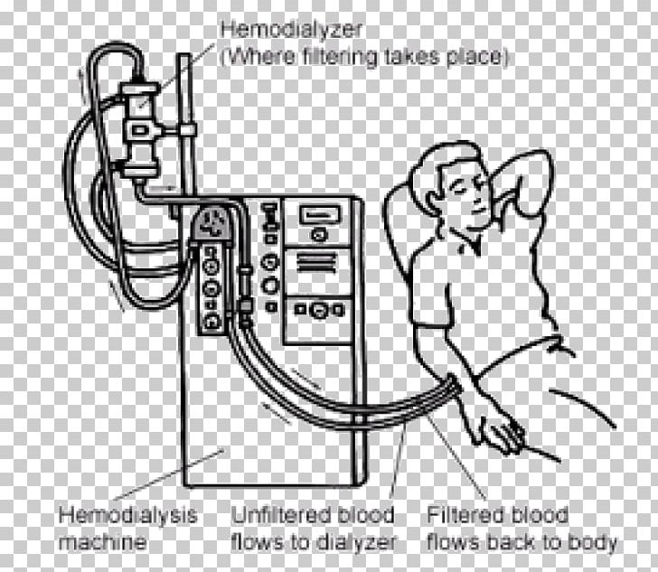 Hemodialysis Kidney Failure Chronic Kidney Disease PNG, Clipart, Angle, Area, Arm, Art, Auto Part Free PNG Download