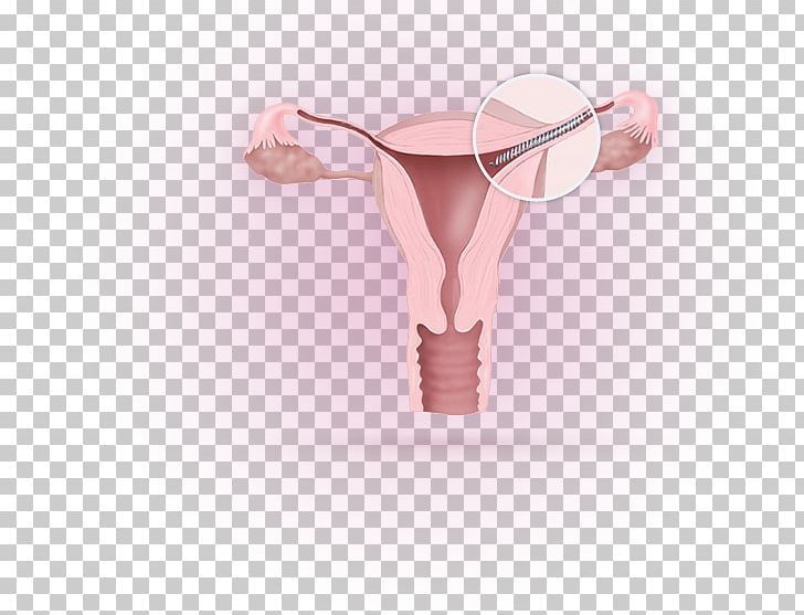 Essure Birth Control Fallopian Tube Sterilization Tubal Ligation PNG, Clipart, Birth Control, Essure, Fallopian Tube, Food And Drug Administration, Hysteroscopy Free PNG Download