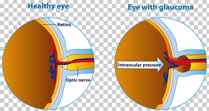 Human Eye Glaucoma Eye Care Professional Optic Nerve PNG, Clipart, Angle, Blindness, Circle, Diagram, Eye Free PNG Download