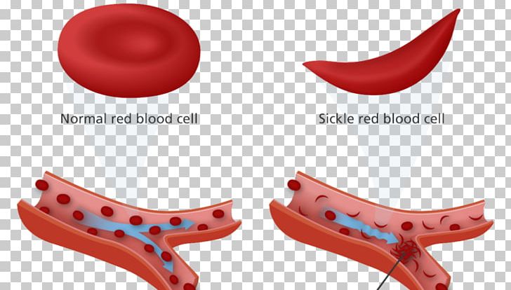Sickle Cell Disease Anemia Sickle Cell Trait Red Blood Cell PNG, Clipart, Anemia, Blood, Blood Cell, Disease, Footwear Free PNG Download