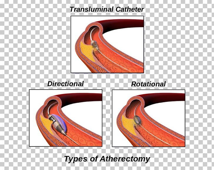 Atherectomy Peripheral Artery Disease Surgery Cleveland Clinic PNG, Clipart, Arteriosclerosis, Artery, Atherectomy, Blood Vessel, Catalan Wikipedia Free PNG Download