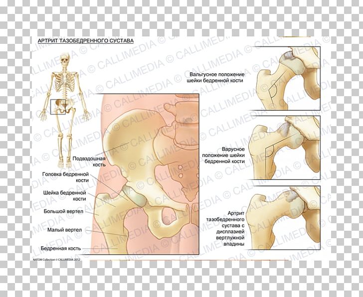 Hip Dysplasia Bone Arthritic Pain Femur PNG, Clipart, Abdomen, Angle, Arm, Arthritis, Bone Free PNG Download