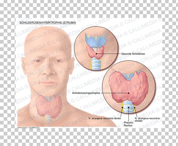 Goitre Thyroid Cancer Graves' Disease PNG, Clipart,  Free PNG Download