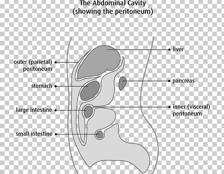Peritoneum Mesothelium Peritoneal Mesothelioma Peritonitis Cancer PNG, Clipart, Angle, Area, Ascites, Hand, Head Free PNG Download