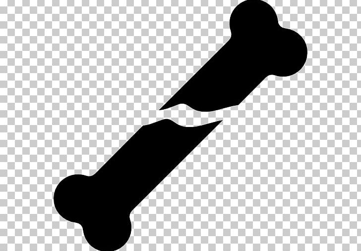 Bone Fracture Computer Icons Finger PNG, Clipart, Anatomy, Arm, Black And White, Bone, Bone Fracture Free PNG Download
