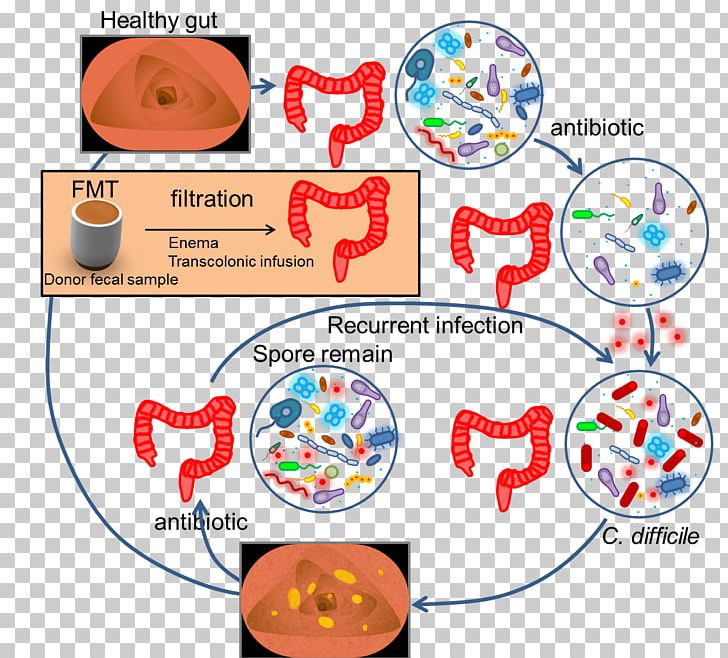 Fecal Microbiota Transplant Feces Ulcerative Colitis Gut Flora Faecal Calprotectin PNG, Clipart, Area, Bacteria, Diarrhea, Fecal Microbiota Transplant, Feces Free PNG Download